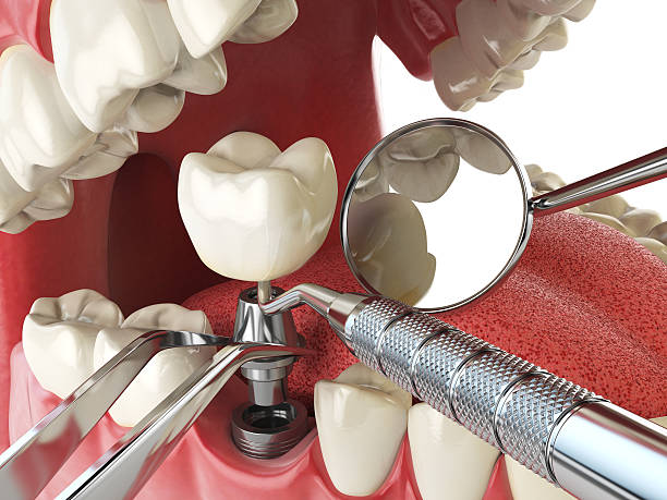 Best Emergency Dentist for Knocked-Out Tooth in Allendale, SC